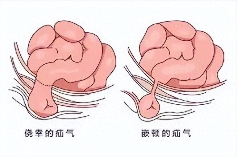 医生提醒:疝气存在多种类型,儿童老人不要忽视-腾讯新闻