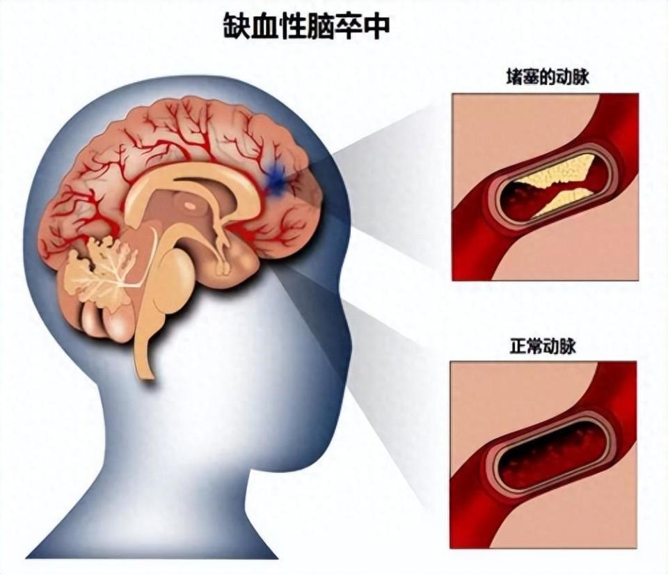 缺血性脑卒中怎么回事?医生提醒:出现这些症状,及时就医!