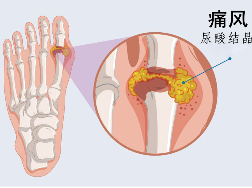 为何痛风总是找上门?日常做好这11个护理!