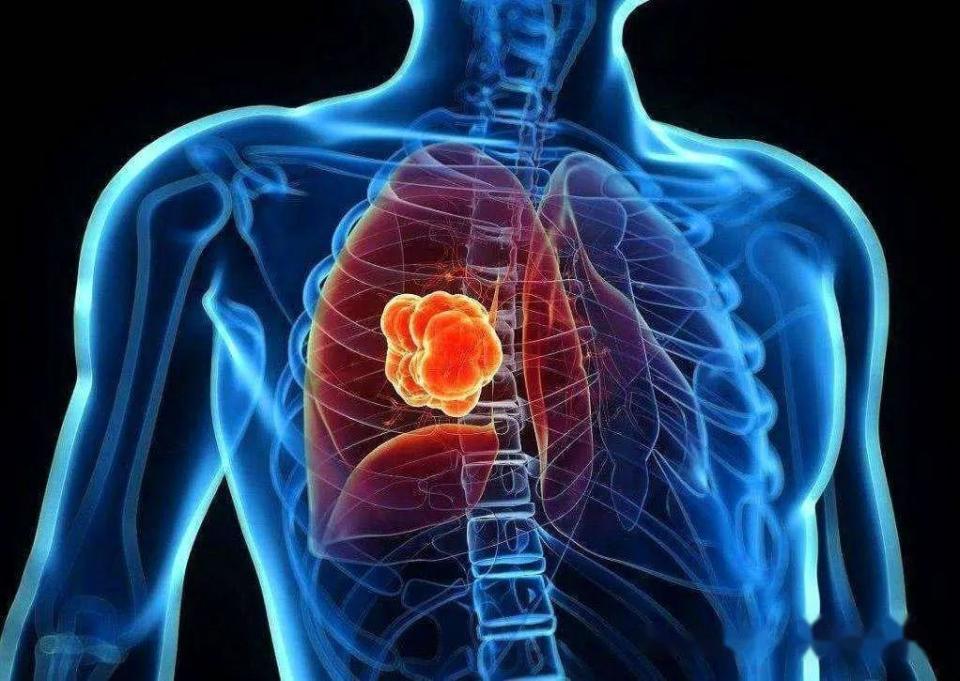 肺癌:悄无声息的杀手,我们如何与之抗争?_腾讯新闻