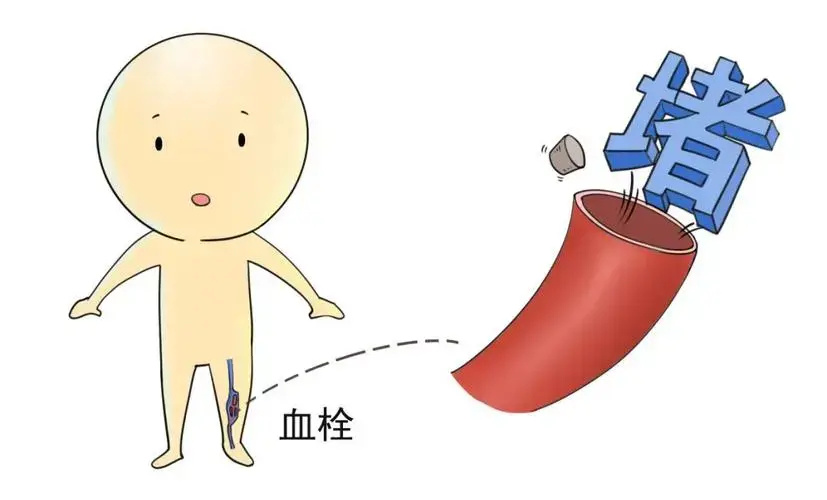 经常提到血栓，血栓到底是什么？有哪些症状？如何治疗？_腾讯新闻