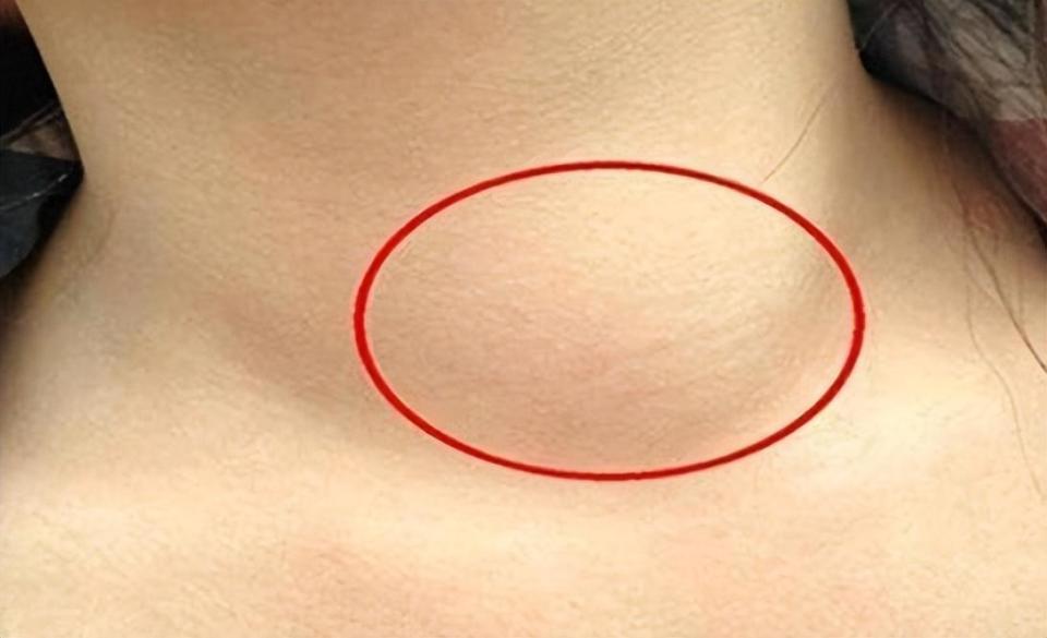 非霍奇金淋巴瘤又细分诸多亚型,如弥漫大b细胞淋巴瘤,滤泡性淋巴瘤,套