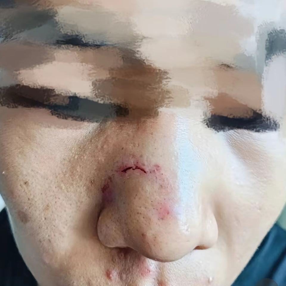 体校学生被教练打断鼻骨?山西省临汾市体育局:正在积极处理