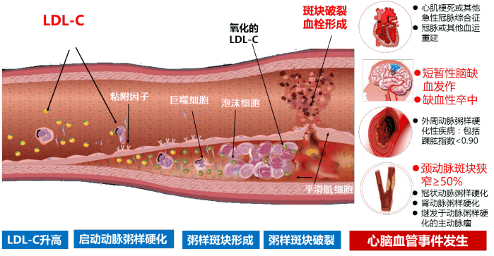 动脉粥样硬化斑块是怎样长成的?