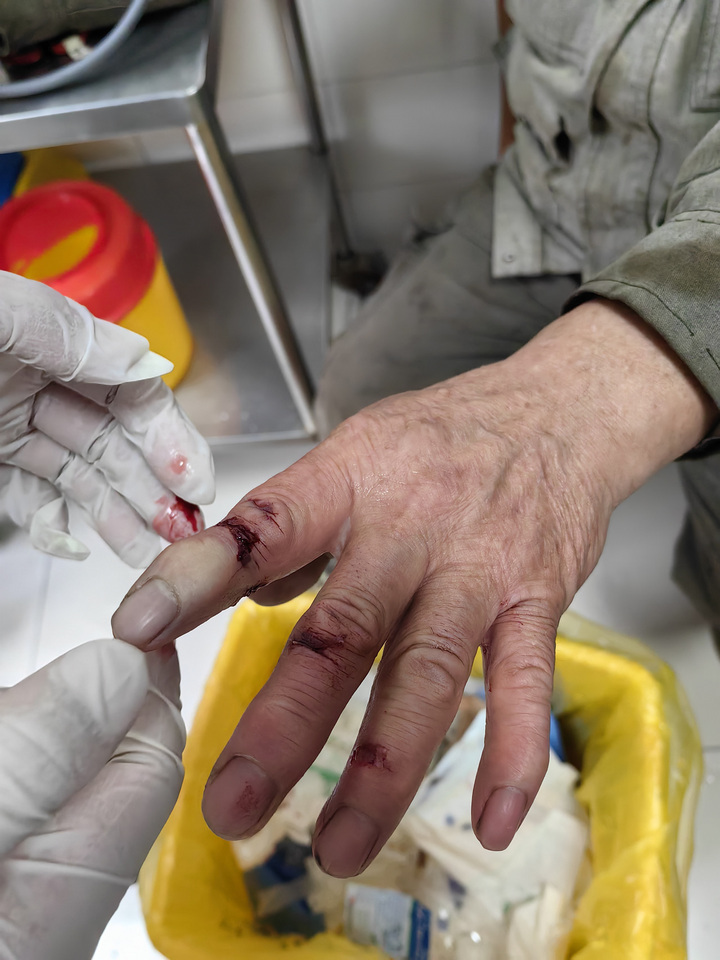 再植手术,是指患者在发生手指