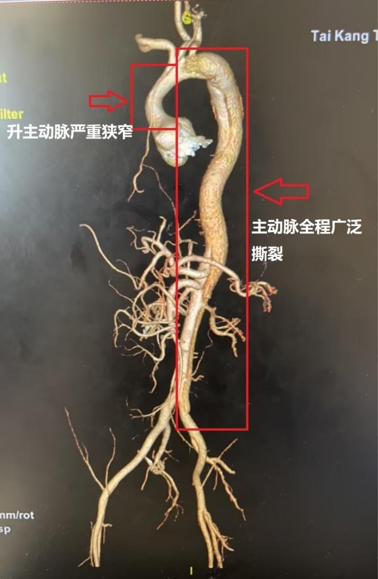 主动脉CTA图片