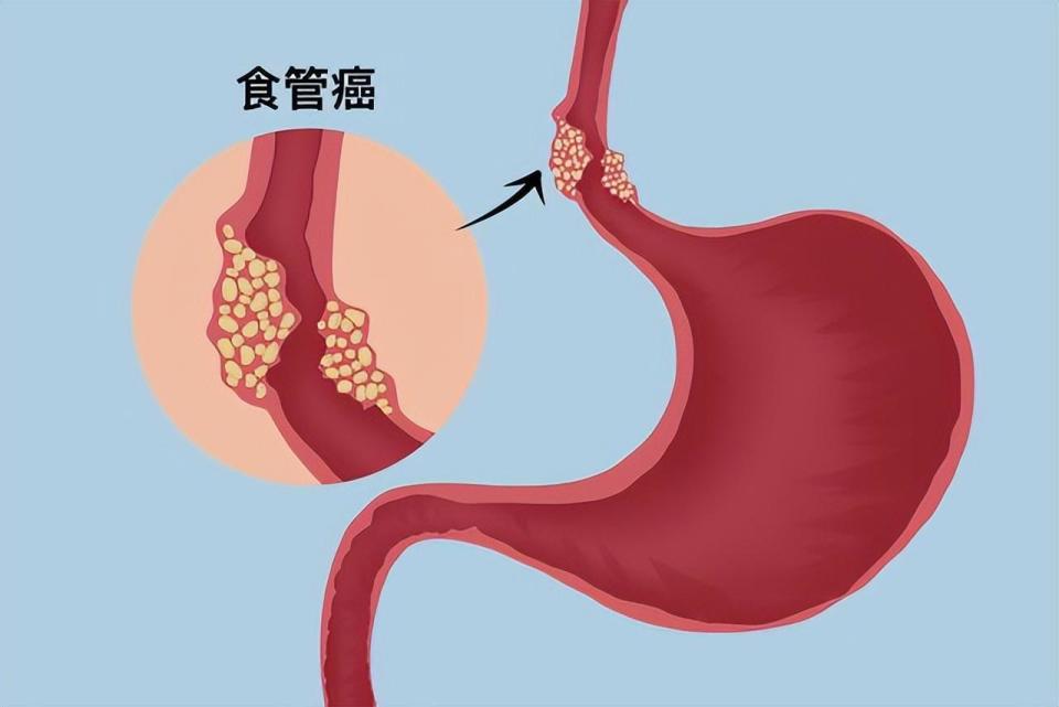 食道癌的早期症状表现图片