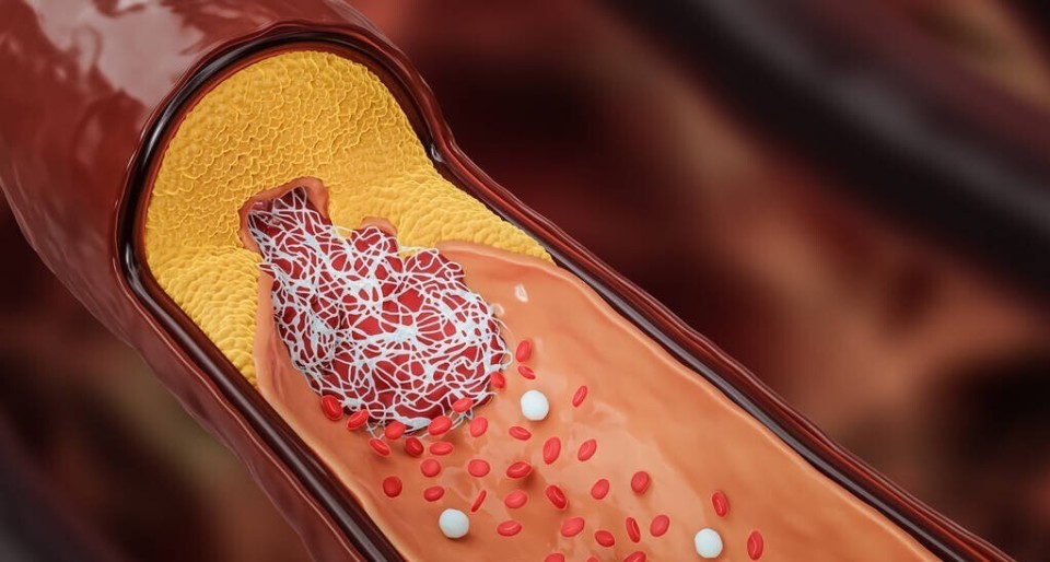 血管的硬化与钙化,哪个更严重,是怎样形成的?