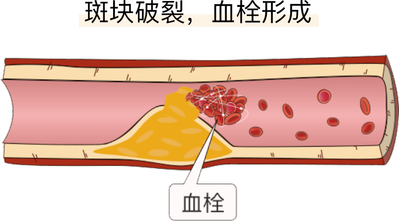 经常提到血栓，血栓到底是什么？有哪些症状？如何治疗？_腾讯新闻
