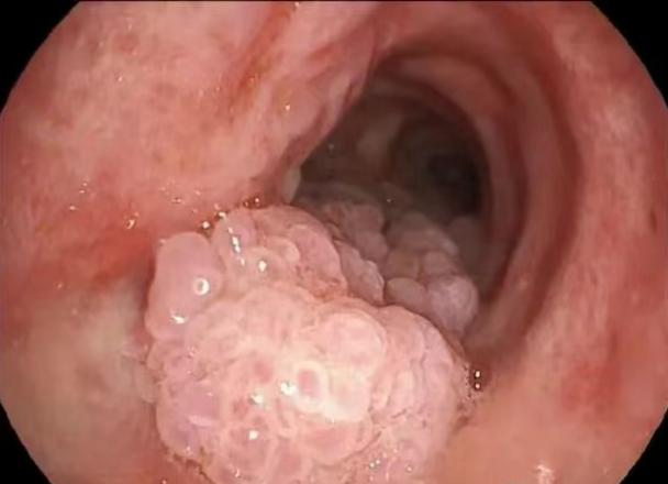 男童喉咙长菜花样肿块