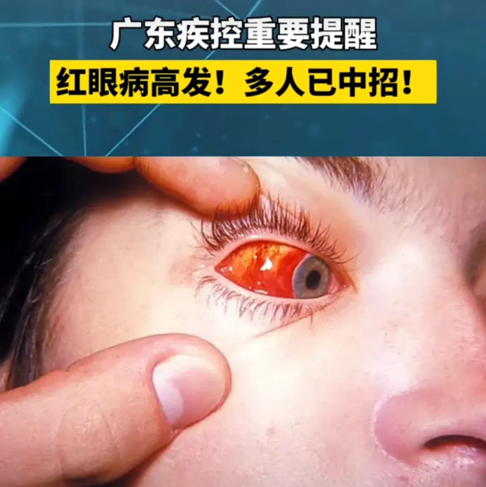 红眼病已进入高发期,该如何预防?-腾讯新闻