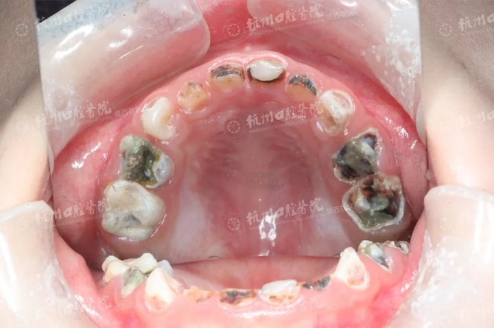 潮健康福利馆 | 100个窝沟封闭(涂氟)名额免费送!赶紧报名