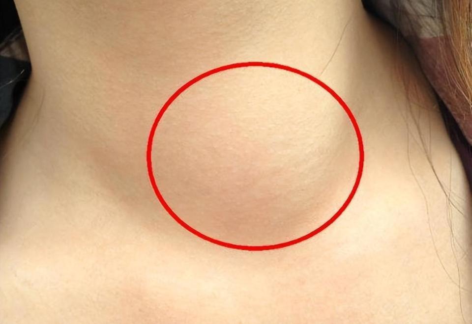 颈部肿块,疼痛,吞咽困难?甲状腺结节在作怪!出现症状及时筛查