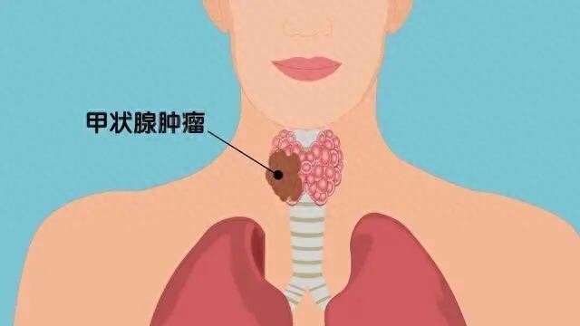 甲状腺癌发病率飙升成第三大‘凶手’？多数患者生存率接近100