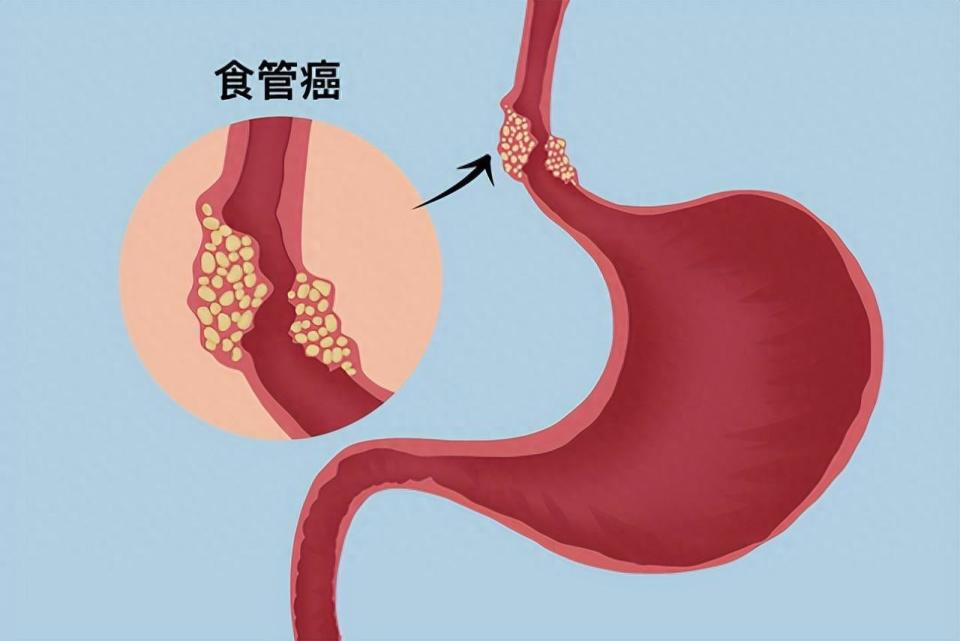 身體出現這些變化,可能是食管癌的預警!做好這10個