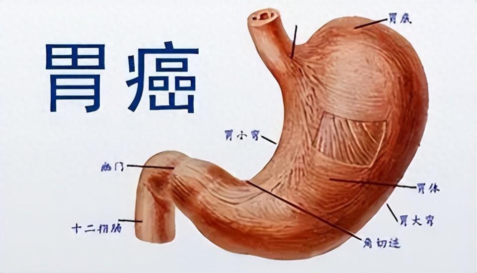 有這些習慣的人小心胃癌醫生提醒早期做好胃癌篩查