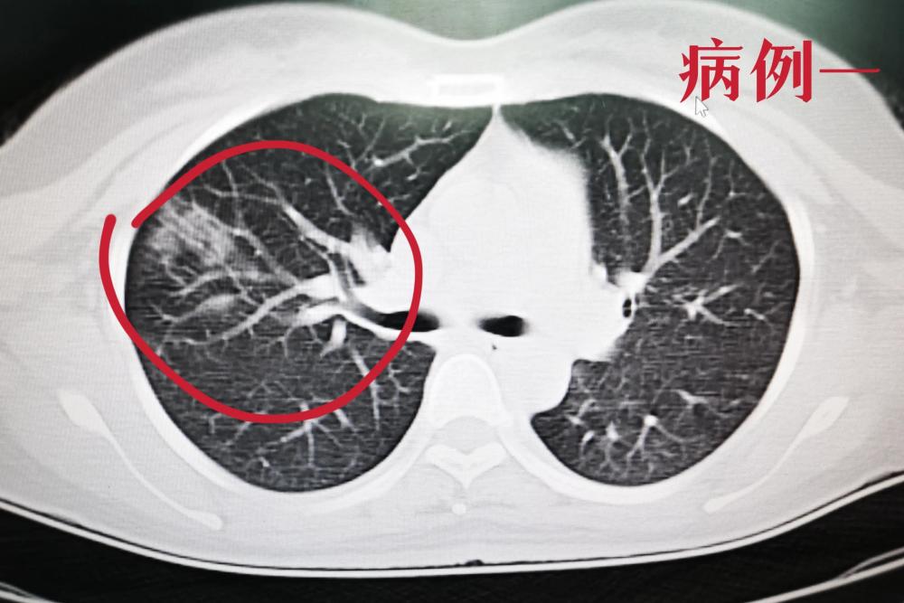 肺炎白肺請別恐慌四類人群要多關注出現這五種症狀要小心