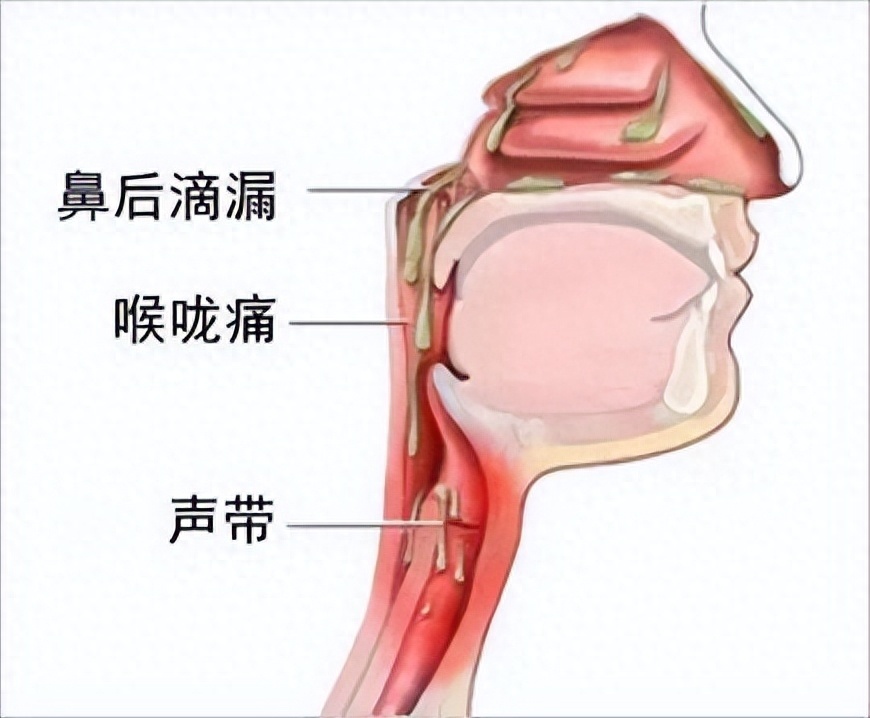 鼻后滴漏综合征是指孩子因患有过敏性鼻炎,慢性鼻炎或鼻窦炎等疾病