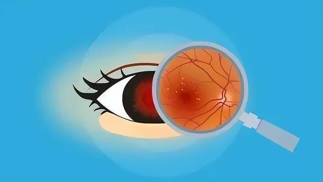 糖尿病视网膜病变怎么回事?做好5点预防,严重了可能会失明