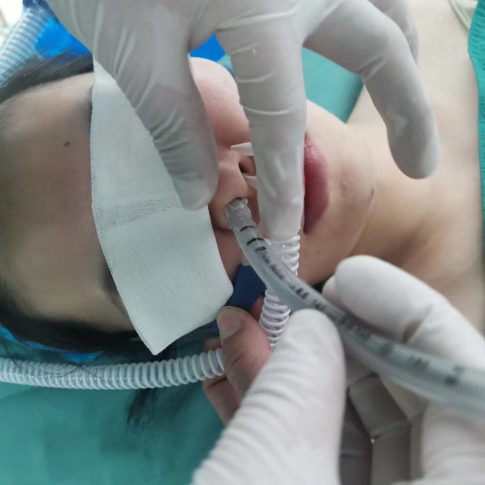 经鼻高流量吸氧用于快诱导经鼻气管插管