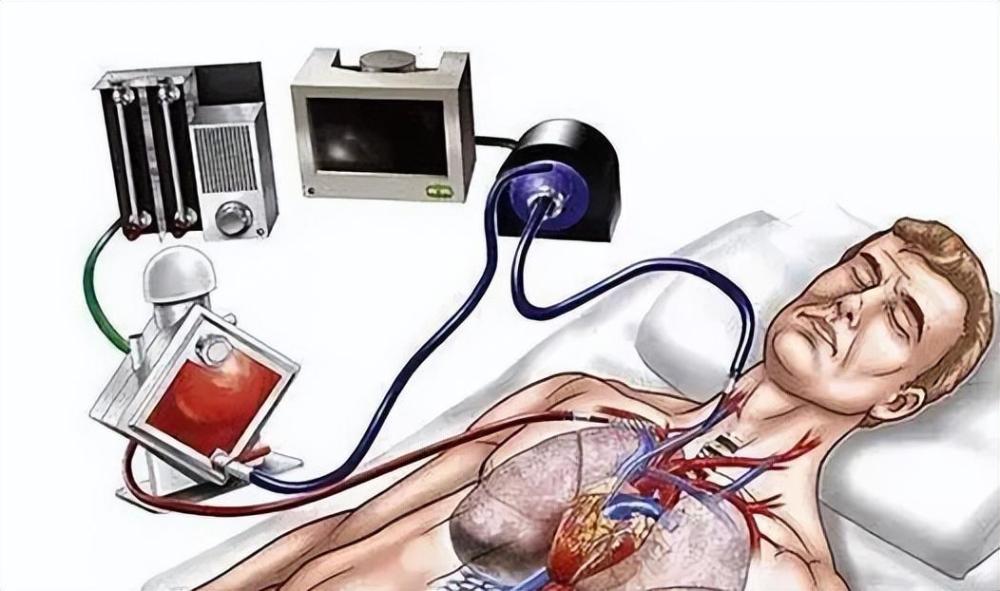 人工肺值得用吗?全球仅4国能造_腾讯新闻