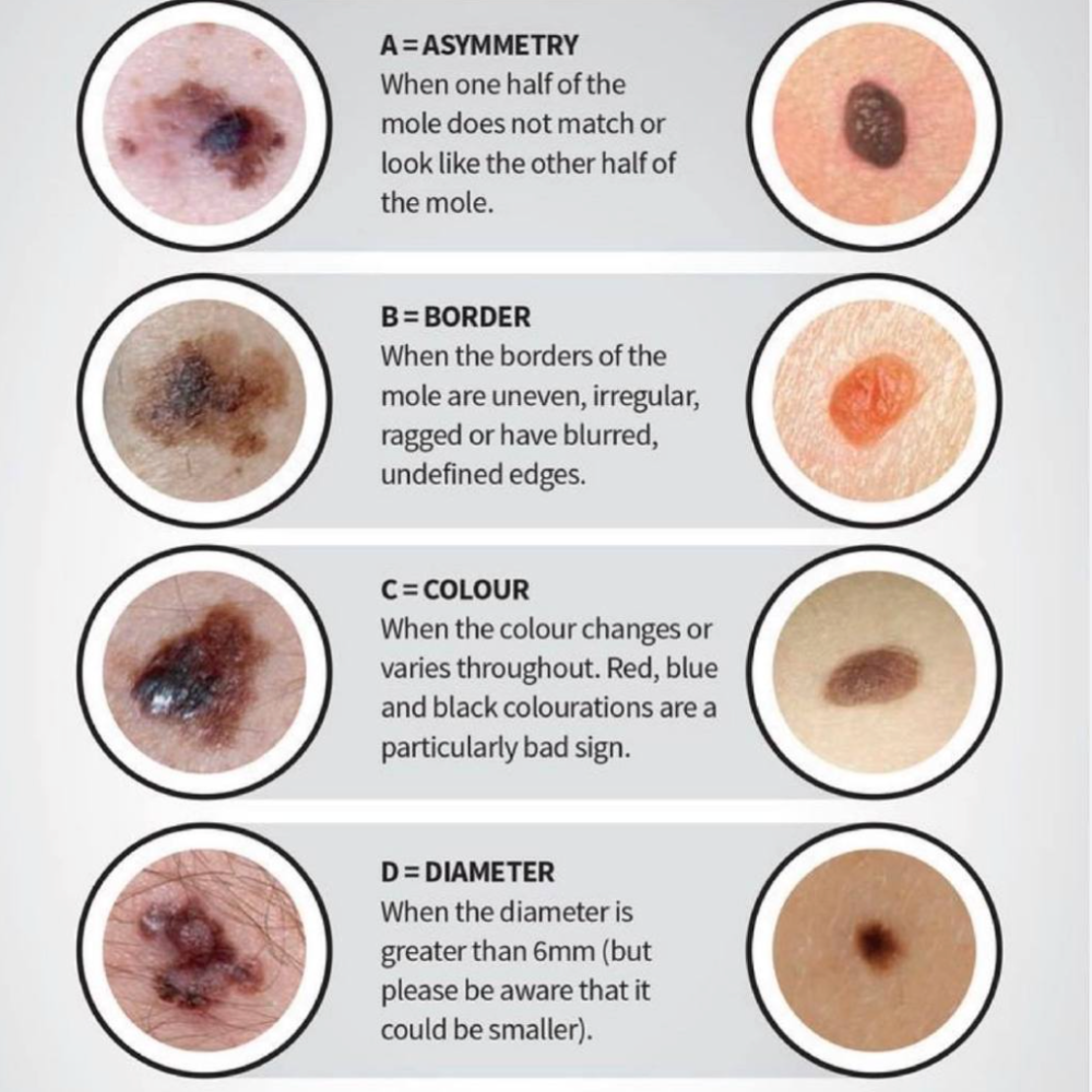 汪峰徒弟去世,患黑色素瘤年仅37岁,网友恐慌:我身上也有痣_腾讯新闻