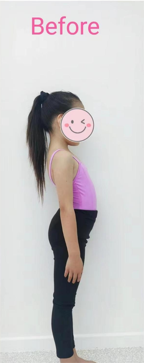 小朋友身材前凸后翘挺肚子撅屁股含胸驼背如何纠正