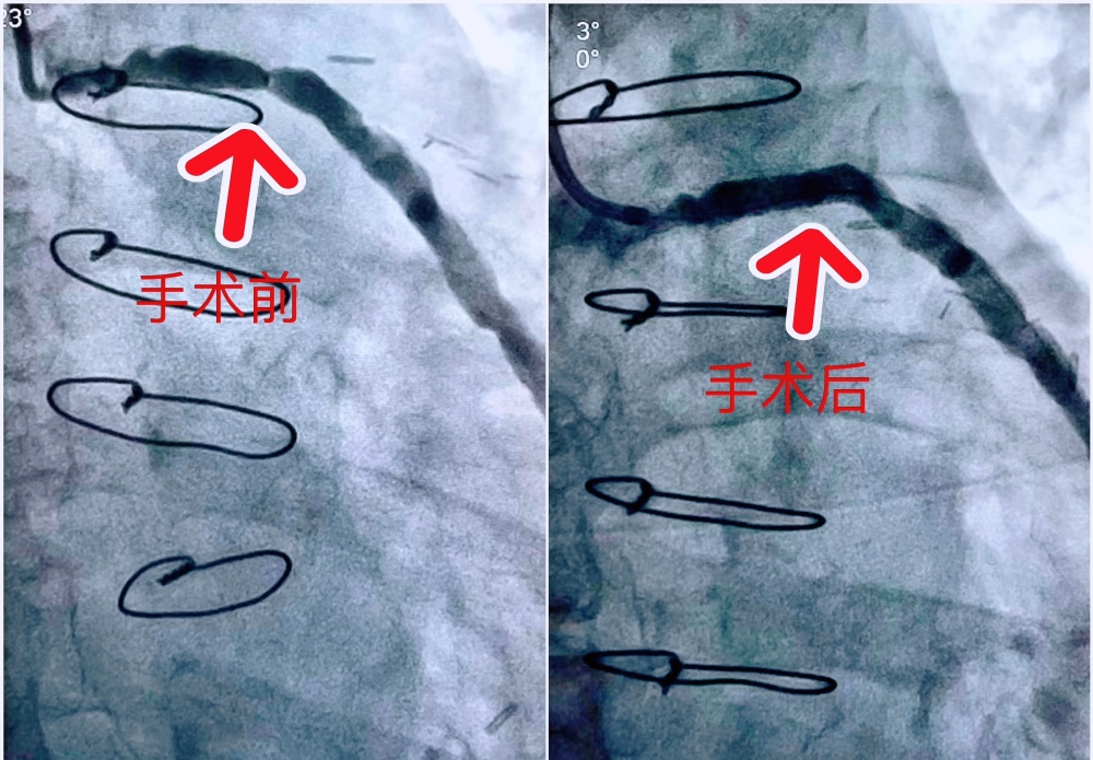 心脏搭桥10年后再次罢工医生微创打通生命线