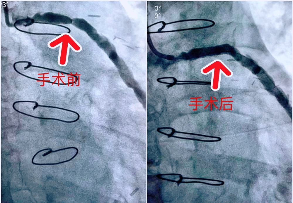 心脏搭桥真实图片图片