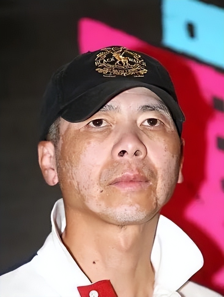 冯小刚不打针不吃药,脸上的白癜风消失了