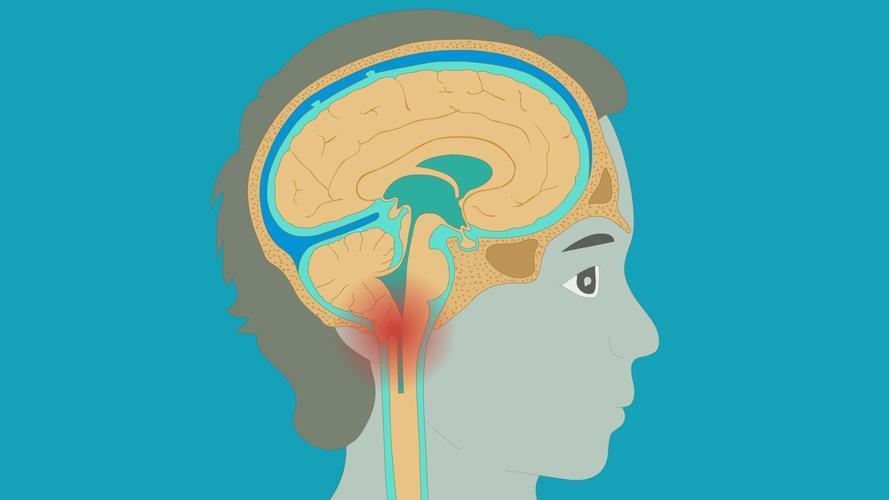 枕骨大孔疝瞳孔特点图片