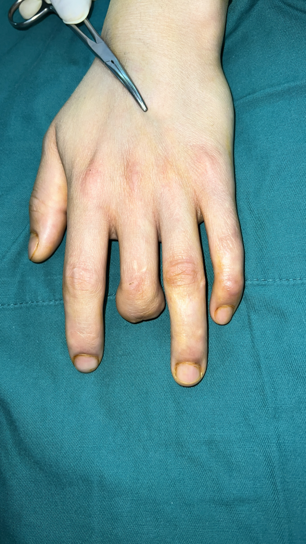 重医大附三院成功完成首例手指全形再造术