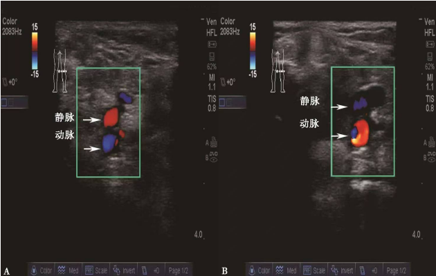 导丝怎么扩规培临床技能：中心静脉置管术全攻略之超声引导下锁骨下静脉穿刺置管术（8）_https://www.jmylbn.com_新闻资讯_第5张