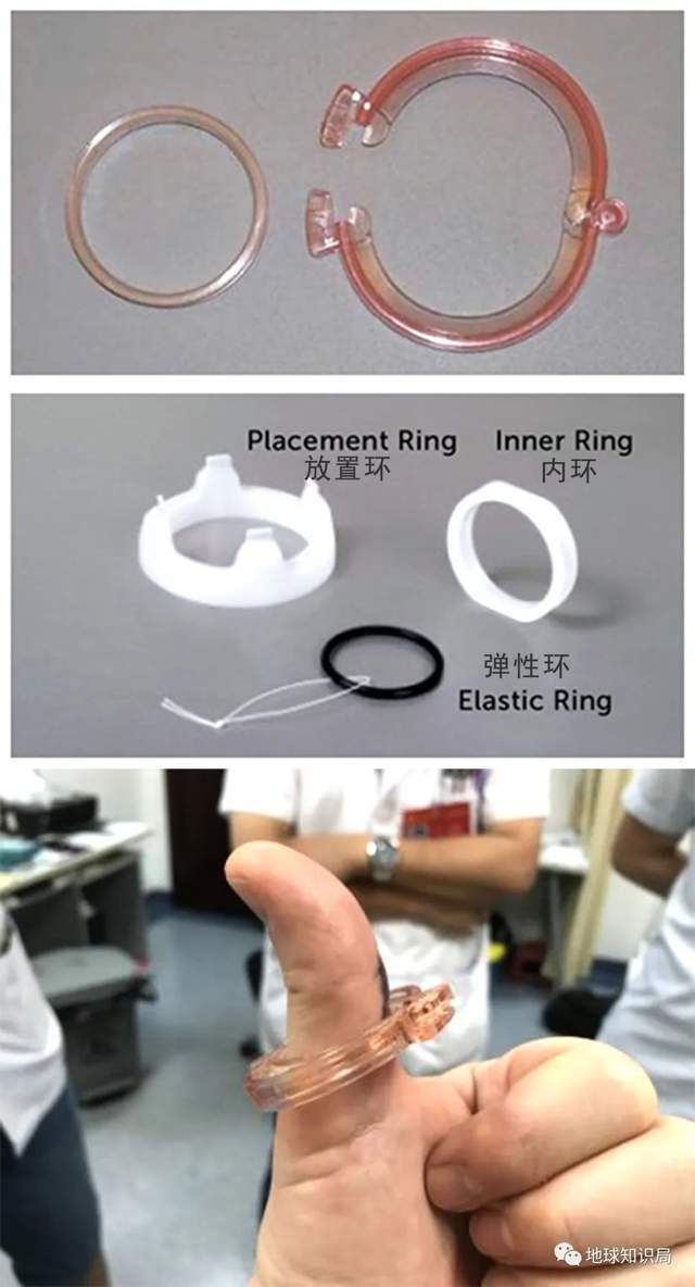 这种手术目前在儿童中比较常用,成年人中应用较少(成年人时不时勃起