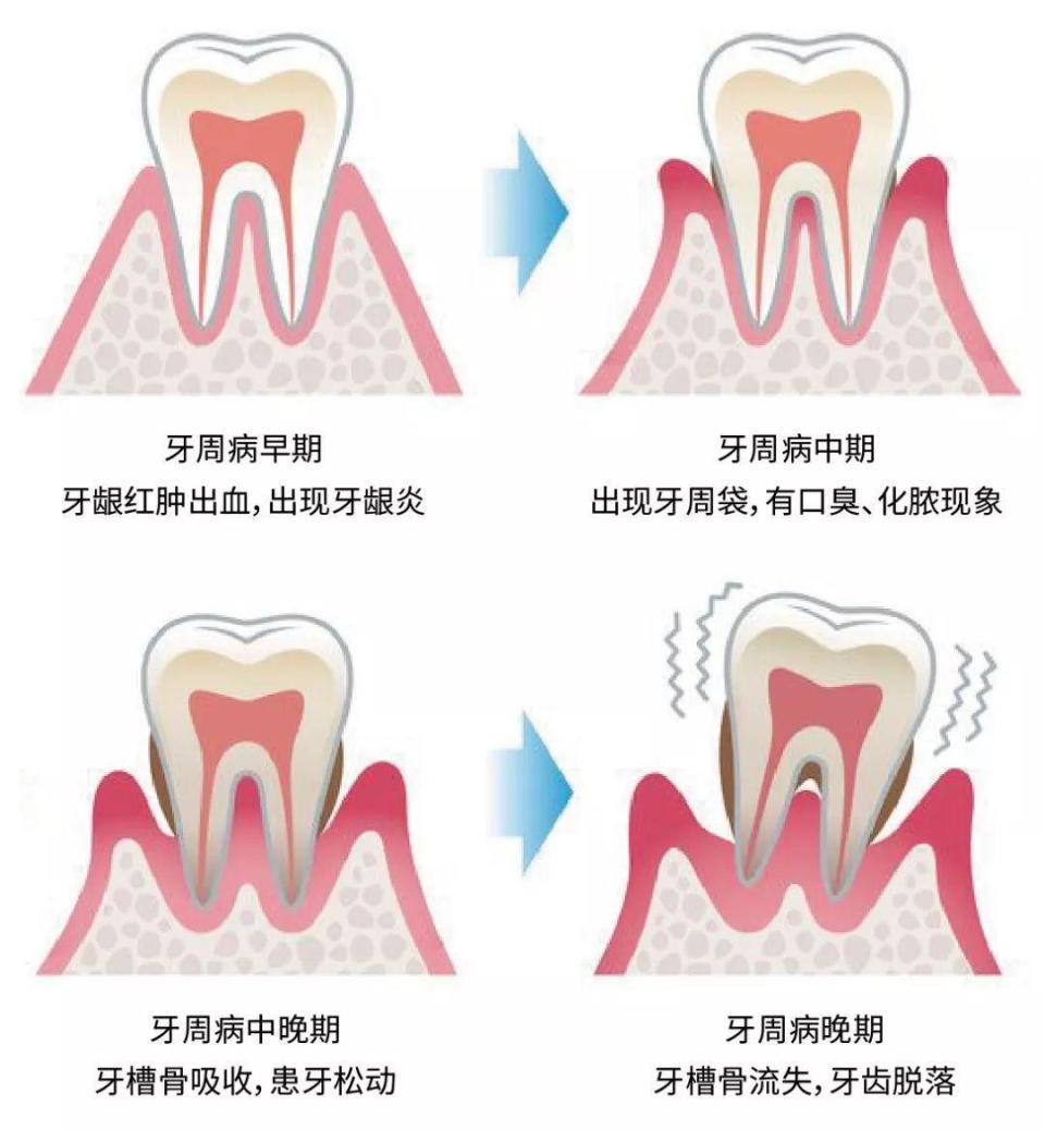 牙周病的治疗方法图片