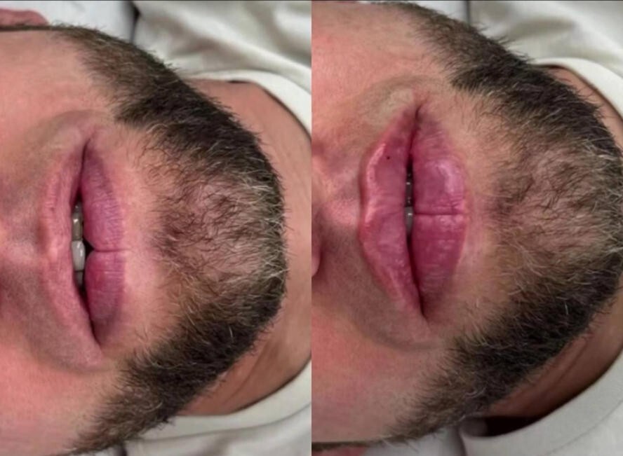 俄罗斯达吉斯坦等地男士兴起丰唇潮流？夜间手术竟因不被允许