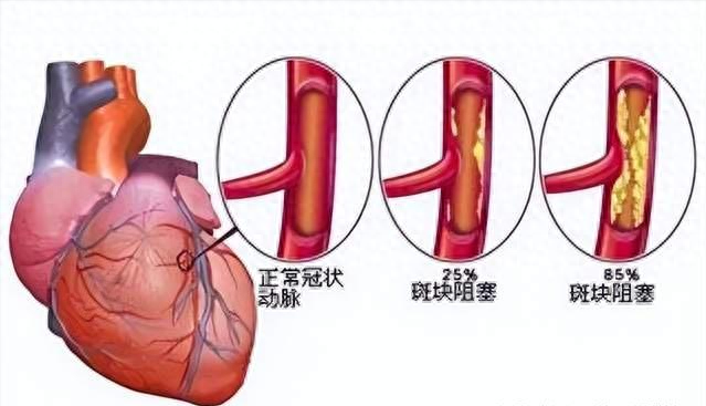 怎样预防血管堵塞?