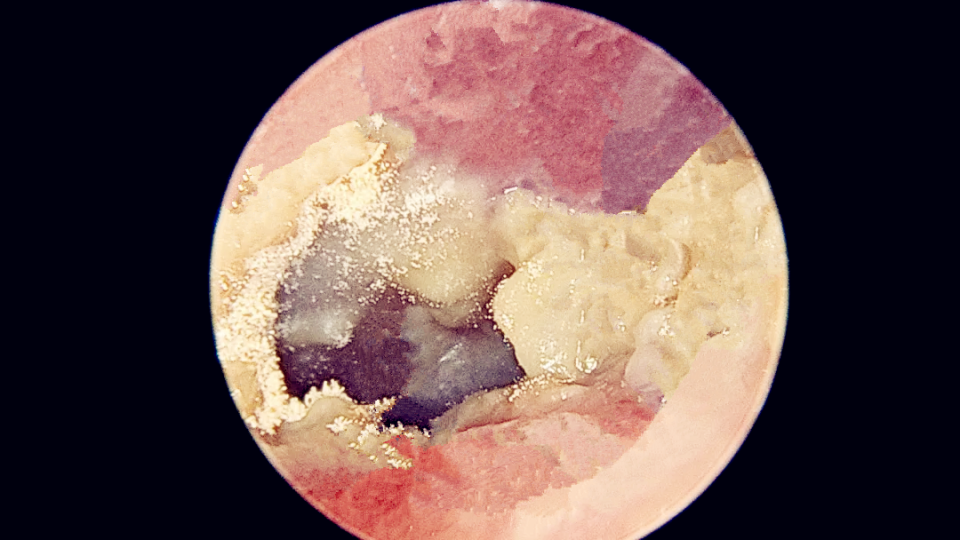 耳屎不是一般的"屎",市面上的采耳服务藏着哪些风险?