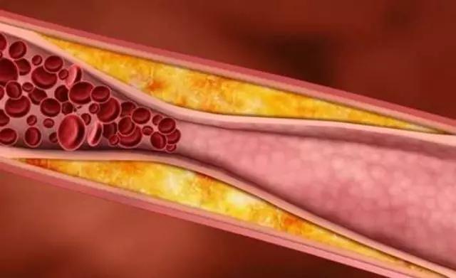 动脉硬化检测仪怎么用每年因动脉硬化导致死亡超过1800万，30岁以后建议五年做一次检查_https://www.jmylbn.com_新闻资讯_第4张