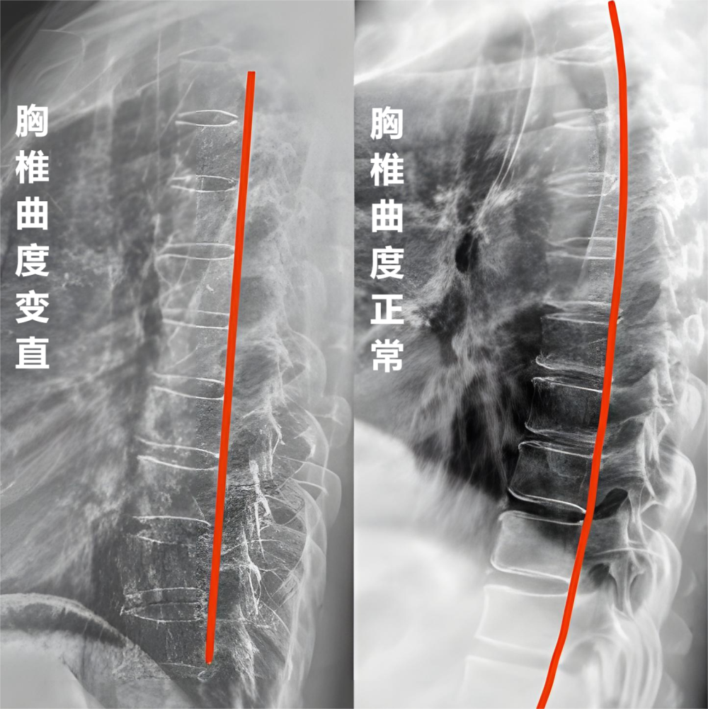 胸椎正侧位图片