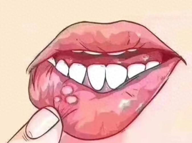 救命！90%的人都遇到过口腔溃疡，它的威力究竟有多大？