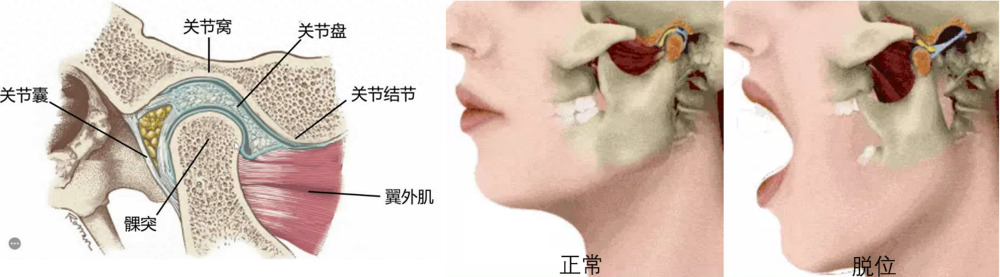 颞下颌关节脱位示意图图片