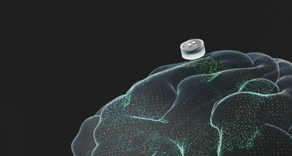 脑机新闻 | Motif Neurotech 获 FDA 批准，启动针对难治性抑郁症的脑机接口首项临床试验_腾讯新闻