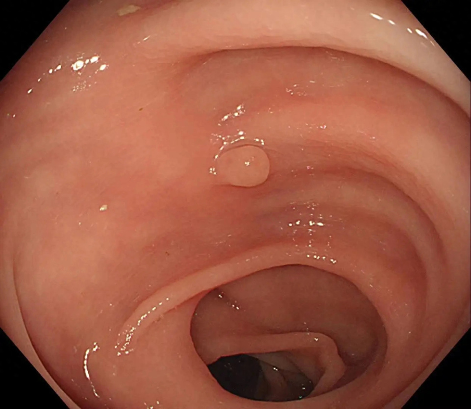 所有肠息肉都需要移除吗?医生提醒:出现这3种症状,快去做检查