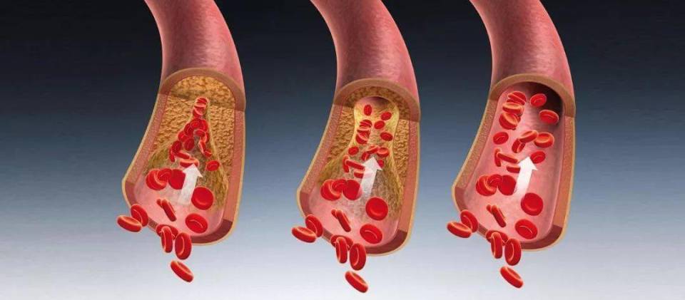 动脉硬化检测仪怎么用每年因动脉硬化导致死亡超过1800万，30岁以后建议五年做一次检查_https://www.jmylbn.com_新闻资讯_第3张