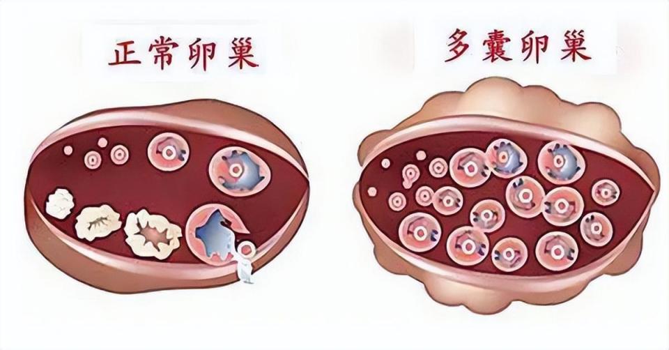 多囊卵巢综合症是个什么病?医生提醒:做好5项预防,远离不孕-腾讯新闻