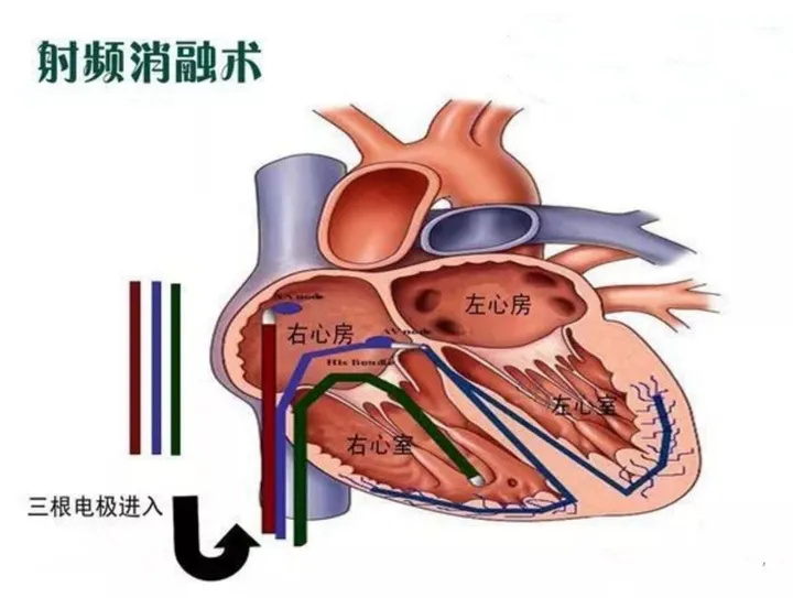 射频消融预后调理及房颤恢复介绍