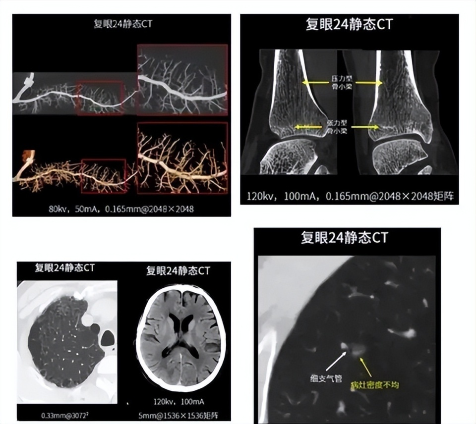 军事技术举一反三！中国推出相控阵CT，全世界首款打破西方定势_腾讯新闻
