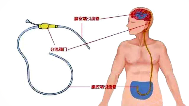 脑脊液引流术图片图片