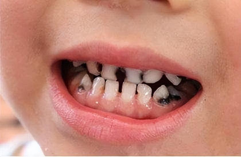 11岁男孩喝可乐后中毒昏迷血糖爆表直接住进icu家长悔不当初